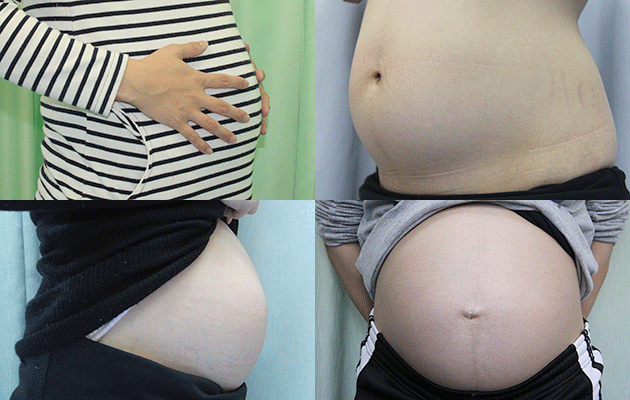妊娠30週、31週、32週の逆子