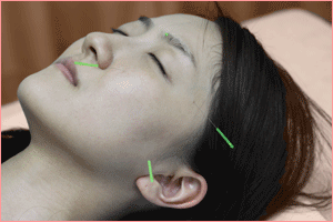 顔面神経麻痺に対する鍼灸治療