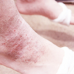 アトピー性皮膚炎の子へ。痛くない、刺さない鍼治療です。